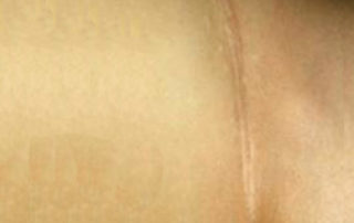 HelenZee.com back-scar-big-320x202  